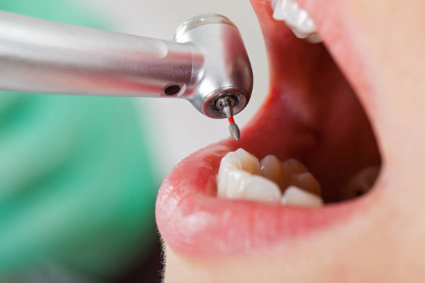 Best Emergency Dentist for Lost Fillings or Crowns in Caledonia, MS